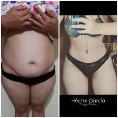 Abdominoplastia Dr Héctor García