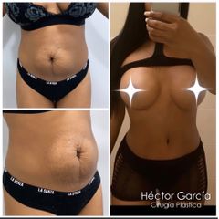 Abdominoplastia Dr Héctor García