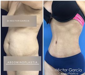 Abdominoplastia Dr Héctor García