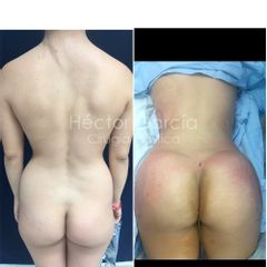 Lipotransferencia Dr Héctor García