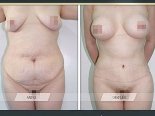 Abdominoplastia
