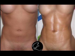 Antes y despues de Lipoescultura High Definition