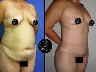 Antes y despues de  abdominoplastia con lipoescultura