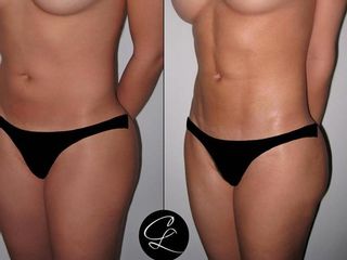 Antes y despues de lipoescultura de alta definición 