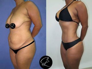Antes y despues de  Abdominoplastia y Lipoescultura CL