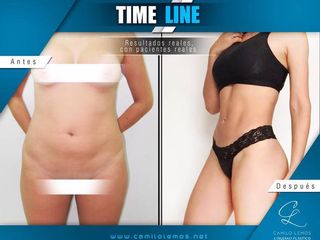 Antes y despues de Lipoescultura Vaser de alta definición