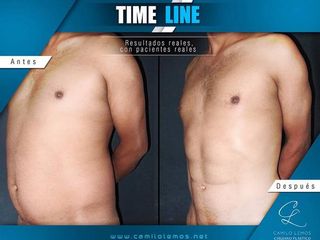Antes y despues de Lipoescultura de Alta Definición con marcación abdominal