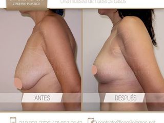 Antes y despues de PEXIA MAMARIA con reducción de volumen 