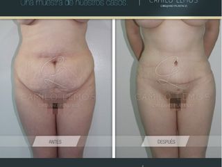 Antes y despues de abdominoplastia
