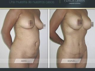 Antes y despues de abdominoplastia