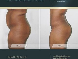 Antes y despues de abdominoplastia