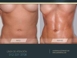 Antes y despues de Lipo de Alta Definición