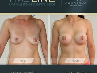 Antes y despues de mamoplastia