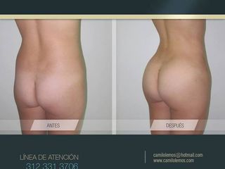 Antes y despues de Aumento de gluteos