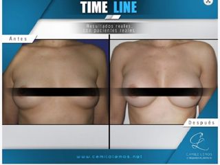 Antes y despues de mamoplastia de aumento