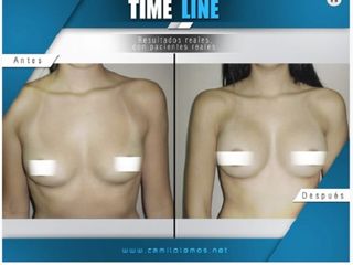 Antes y despues de mamoplastia de aumento