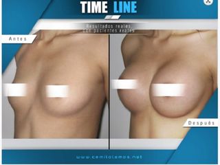 Antes y despues de mamoplastia de aumento