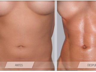 Antes y despues de lipoescultura de alta definicion