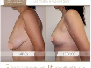Antes y despues de mamoplastia de reduccion