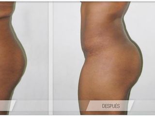Antes y despues de aumento de gluteos