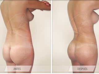 Antes y despues de aumento de gluteos