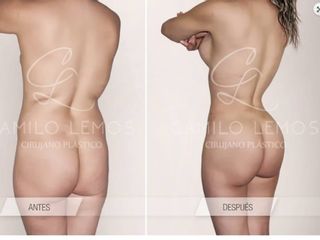 Antes y despues de aumento de gluteos
