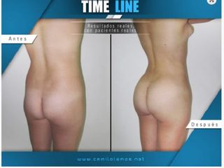 Antes y despues de aumento de gluteos