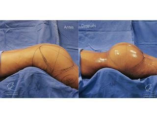 Gluteoplastia - Dr. Camilo Lemos