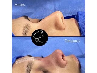 Rinoplastia - Dr. Camilo Lemos