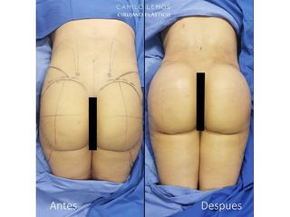 Gluteoplastia - Dr. Camilo Lemos