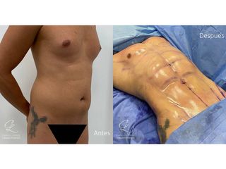 Abdominoplastia - Dr. Camilo Lemos