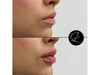 Aumento de labios - Dr. Camilo Lemos