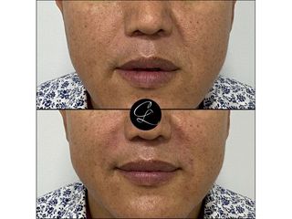 Aumento de labios - Dr. Camilo Lemos