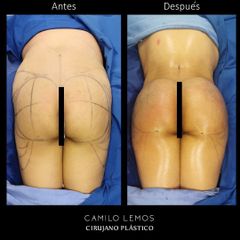 Gluteoplastia - Dr. Camilo Lemos