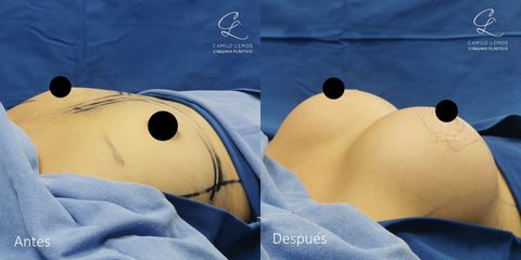 Mamoplastia de aumento - Dr. Camilo Lemos