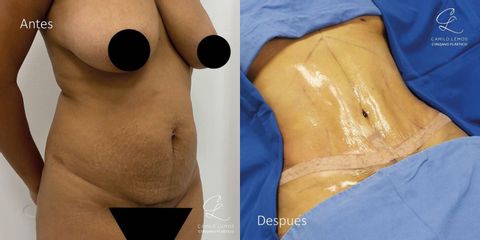 Abdominoplastia - Dr. Camilo Lemos
