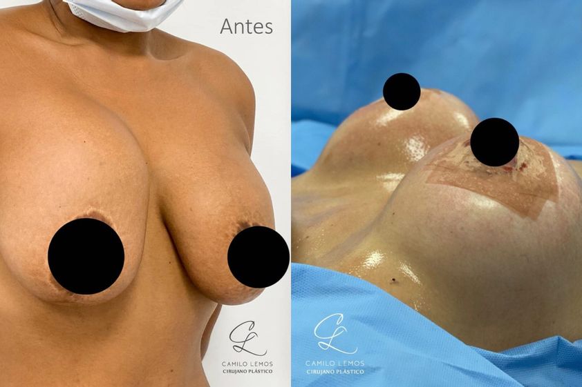 Levantamiento de senos antes y después - 788420