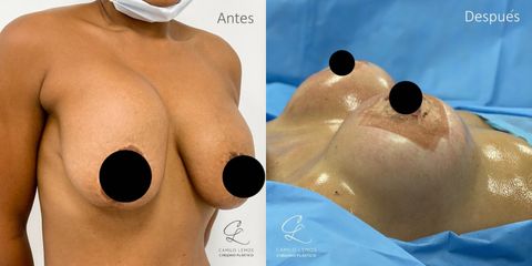 Levantamiento de senos - Dr. Camilo Lemos