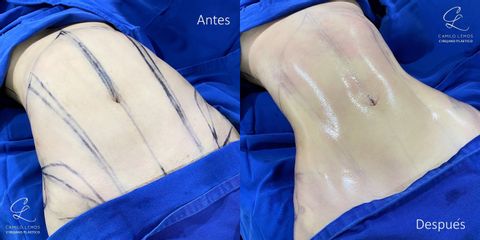 Abdominoplastia - Dr. Camilo Lemos