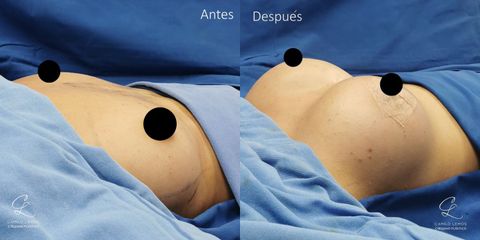 Mamoplastia de aumento - Dr. Camilo Lemos