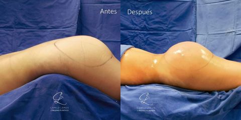 Gluteoplastia - Dr. Camilo Lemos