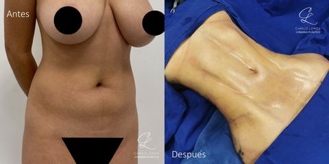 Abdominoplastia - Dr. Camilo Lemos