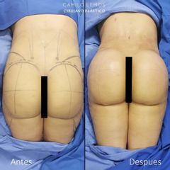 Gluteoplastia - Dr. Camilo Lemos