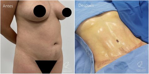 Abdominoplastia - Dr. Camilo Lemos