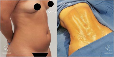 Abdominoplastia - Dr. Camilo Lemos