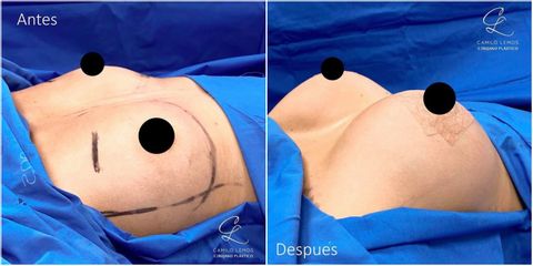 Mamoplastia de aumento - Dr. Camilo Lemos