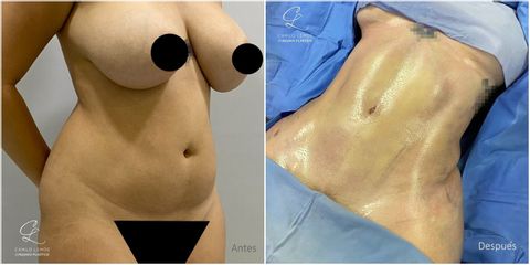 Abdominoplastia - Dr. Camilo Lemos