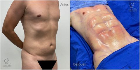 Abdominoplastia - Dr. Camilo Lemos