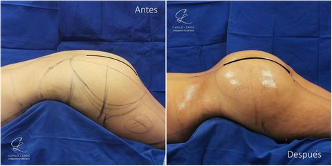 Gluteoplastia - Dr. Camilo Lemos