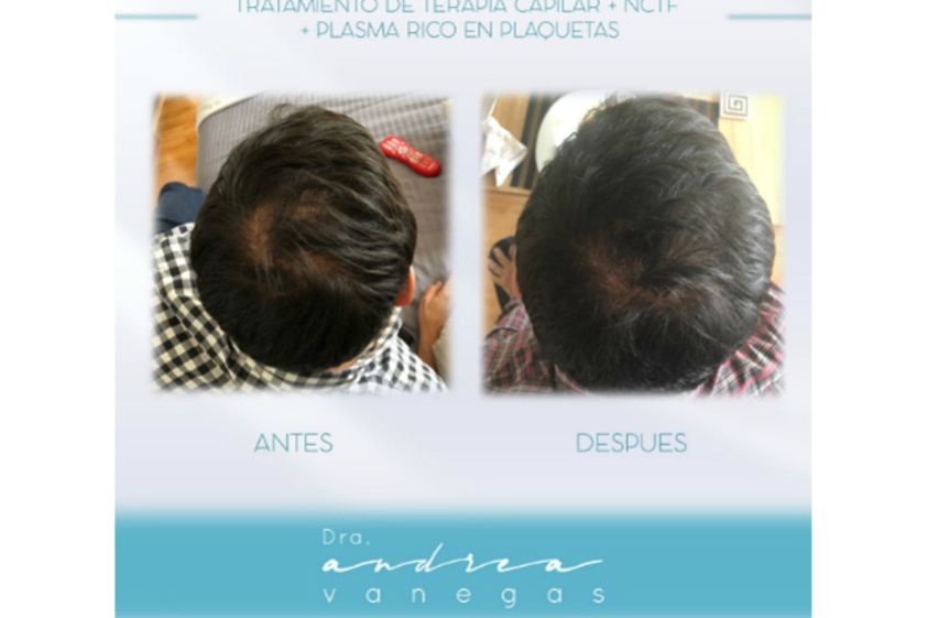 Plasma rico en plaquetas antes y después - 627898